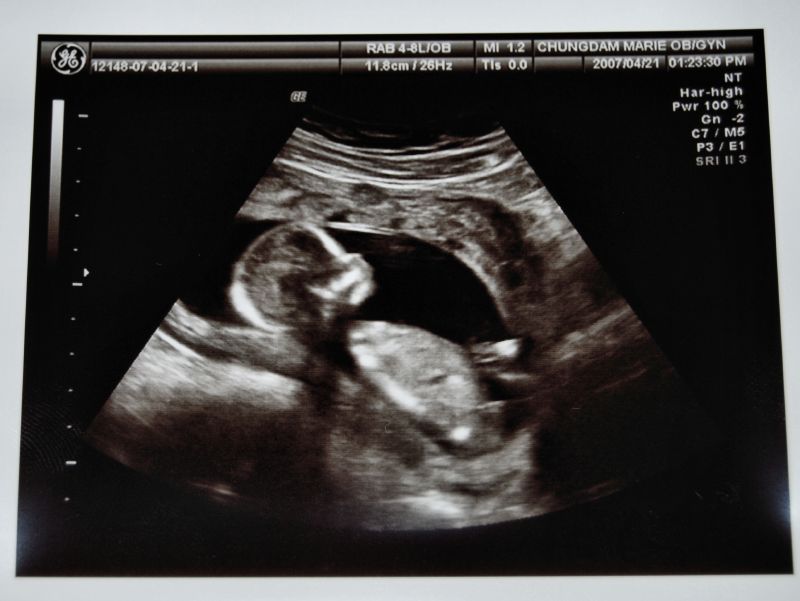 Фото узи 14 недель беременности мальчик