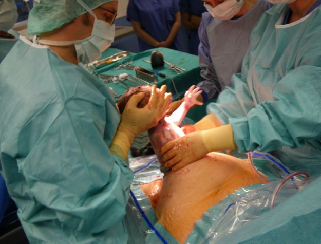 Cirurgia cesariana