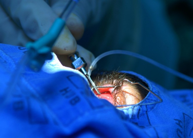transplante de córnea